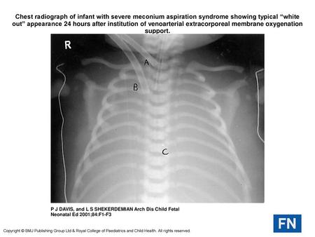 Chest radiograph of infant with severe meconium aspiration syndrome showing typical “white out” appearance 24 hours after institution of venoarterial extracorporeal.