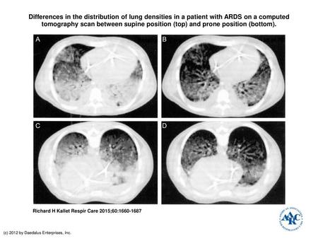 Differences in the distribution of lung densities in a patient with ARDS on a computed tomography scan between supine position (top) and prone position.