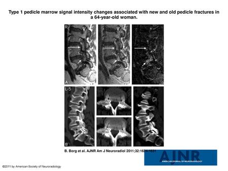 Type 1 pedicle marrow signal intensity changes associated with new and old pedicle fractures in a 64-year-old woman. Type 1 pedicle marrow signal intensity.