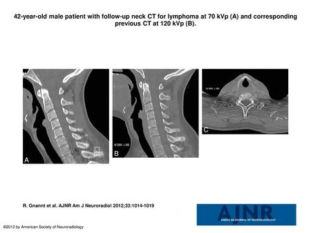 42-year-old male patient with follow-up neck CT for lymphoma at 70 kVp (A) and corresponding previous CT at 120 kVp (B). 42-year-old male patient with.