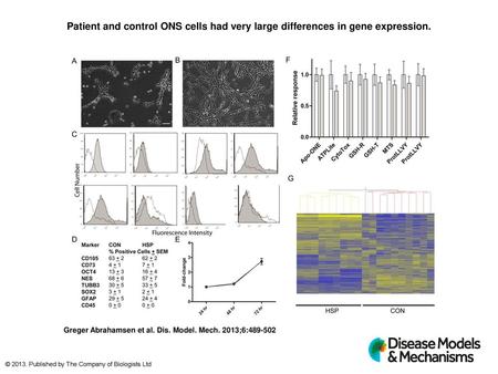 Patient and control ONS cells had very large differences in gene expression. Patient and control ONS cells had very large differences in gene expression.