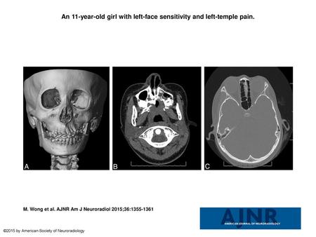 An 11-year-old girl with left-face sensitivity and left-temple pain.