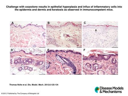 Challenge with oxazolone results in epithelial hyperplasia and influx of inflammatory cells into the epidermis and dermis and keratosis as observed in.