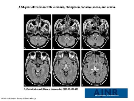 A 54-year-old woman with leukemia, changes in consciousness, and ataxia. A 54-year-old woman with leukemia, changes in consciousness, and ataxia. FLAIR.