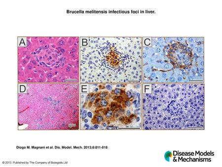 Brucella melitensis infectious foci in liver.