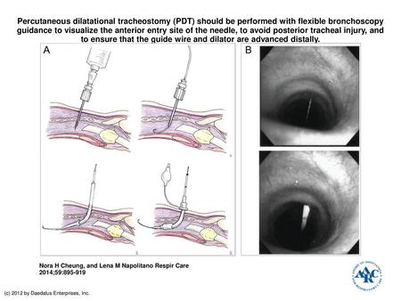 Percutaneous dilatational tracheostomy (PDT) should be performed with flexible bronchoscopy guidance to visualize the anterior entry site of the needle,