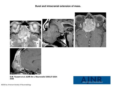Dural and intracranial extension of mass.