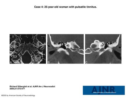 Case 4: 25-year-old woman with pulsatile tinnitus.