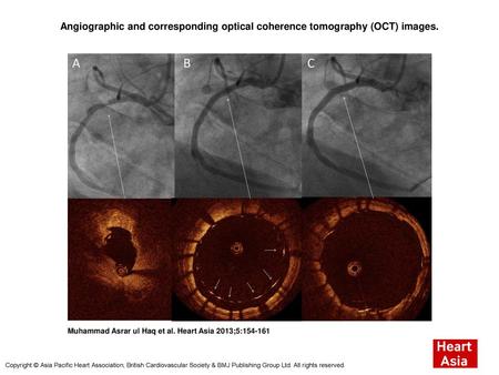 Angiographic and corresponding optical coherence tomography (OCT) images. Angiographic and corresponding optical coherence tomography (OCT) images. (A)