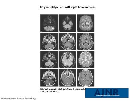 63-year-old patient with right hemiparesis.