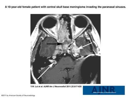 A 10-year-old female patient with central skull base meningioma invading the paranasal sinuses. A 10-year-old female patient with central skull base meningioma.