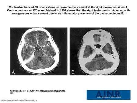 Contrast-enhanced CT scans show increased enhancement at the right cavernous sinus.A, Contrast-enhanced CT scan obtained in 1994 shows that the right tentorium.