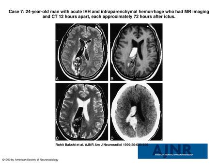 Case 7: 24-year-old man with acute IVH and intraparenchymal hemorrhage who had MR imaging and CT 12 hours apart, each approximately 72 hours after ictus.