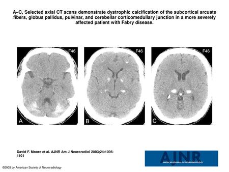 A–C, Selected axial CT scans demonstrate dystrophic calcification of the subcortical arcuate fibers, globus pallidus, pulvinar, and cerebellar corticomedullary.