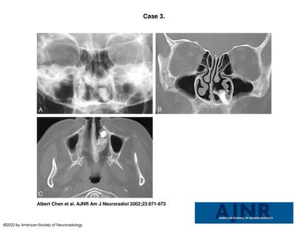 Case 3. Case 3. Images in a 59-year-old woman with an ectopic tooth on the left hard palate complicated by Aspergillus rhinitis.A, Plain-film radiograph.