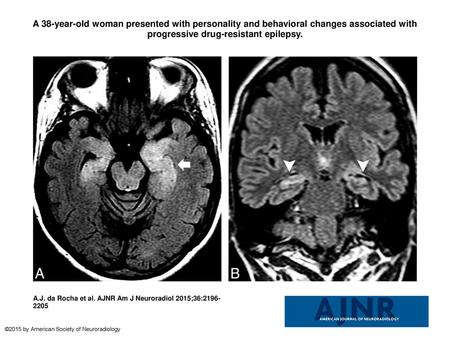 A 38-year-old woman presented with personality and behavioral changes associated with progressive drug-resistant epilepsy. A 38-year-old woman presented.