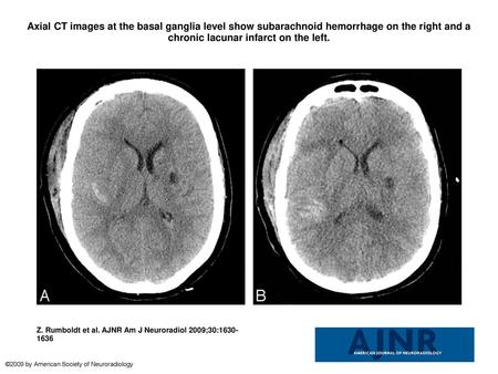 Axial CT images at the basal ganglia level show subarachnoid hemorrhage on the right and a chronic lacunar infarct on the left. Axial CT images at the.
