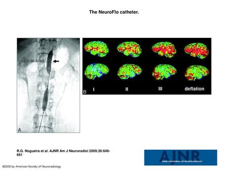 The NeuroFlo catheter. The NeuroFlo catheter. A, Fluoroscopic images demonstrate the suprarenal (black arrow) and infrarenal (white arrow) balloons. B,