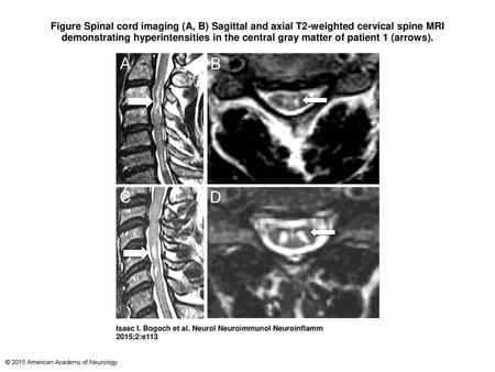 Figure Spinal cord imaging (A, B) Sagittal and axial T2-weighted cervical spine MRI demonstrating hyperintensities in the central gray matter of patient.