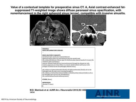 Value of a contextual template for preoperative sinus CT