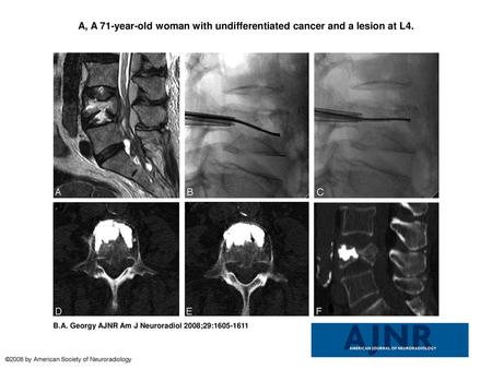 A, A 71-year-old woman with undifferentiated cancer and a lesion at L4