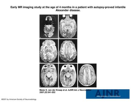 Early MR imaging study at the age of 4 months in a patient with autopsy-proved infantile Alexander disease. Early MR imaging study at the age of 4 months.