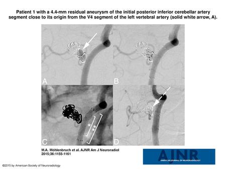 Patient 1 with a 4.4-mm residual aneurysm of the initial posterior inferior cerebellar artery segment close to its origin from the V4 segment of the left.