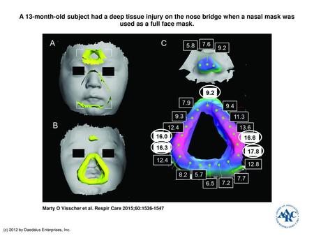 A 13-month-old subject had a deep tissue injury on the nose bridge when a nasal mask was used as a full face mask. A 13-month-old subject had a deep tissue.
