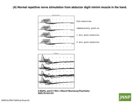  (A) Normal repetitive nerve stimulation from abductor digiti minimi muscle in the hand.  (A) Normal repetitive nerve stimulation from abductor digiti.