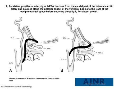 A, Persistent proatlantal artery type I (PPA 1) arises from the caudal part of the internal carotid artery and courses along the anterior aspect of the.