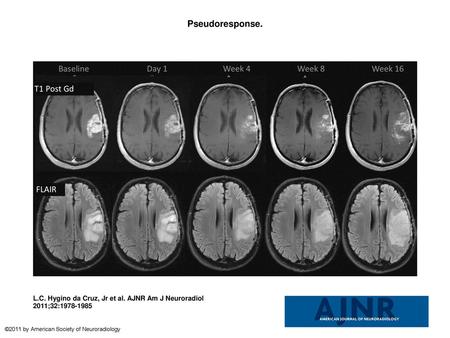 Pseudoresponse. Pseudoresponse. A 47-year-old man with GBM. A reduction of the enhancing portion of the lesion is observed 1 day after initiation of cediranib.