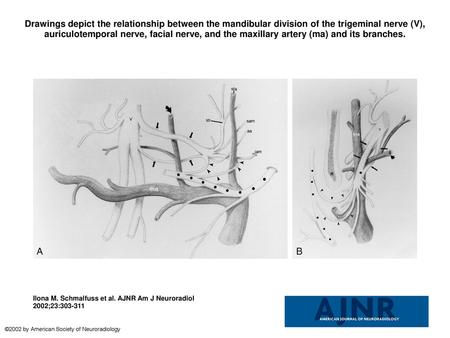 Drawings depict the relationship between the mandibular division of the trigeminal nerve (V), auriculotemporal nerve, facial nerve, and the maxillary artery.