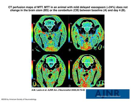 CT perfusion maps of MTT