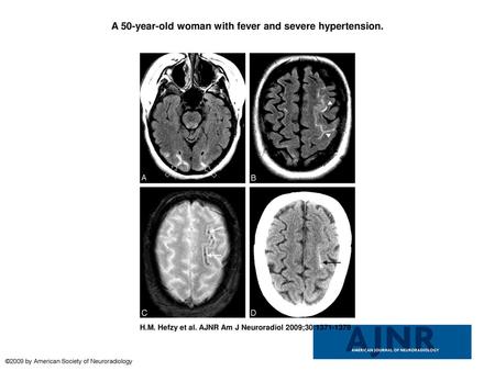 A 50-year-old woman with fever and severe hypertension.