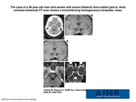 The case of a 40-year-old man who awoke with severe bilateral retro-orbital pain.A, Axial contrast-enhanced CT scan shows a nonenhancing homogeneous intrasellar.