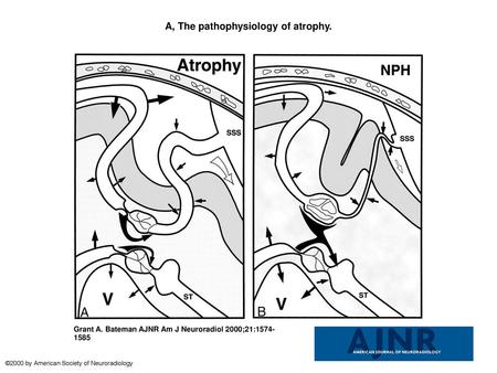 A, The pathophysiology of atrophy.