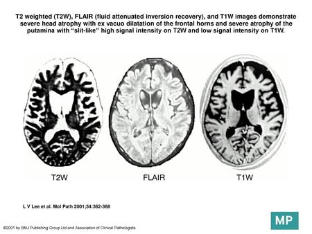 T2 weighted (T2W), FLAIR (fluid attenuated inversion recovery), and T1W images demonstrate severe head atrophy with ex vacuo dilatation of the frontal.