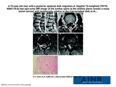 A 75-year-old man with a posterior epidural disk migration