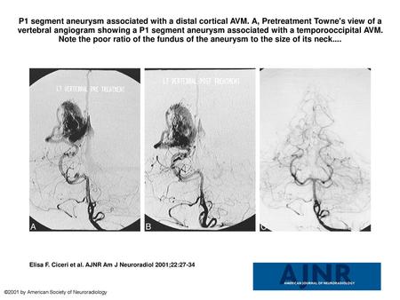 P1 segment aneurysm associated with a distal cortical AVM
