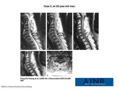 Case 2, an 82-year-old man. Case 2, an 82-year-old man. MR images of the cervical spine, obtained 4 hours after a fall, reveal a large SEH in the dorsal.