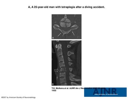 A, A 25-year-old man with tetraplegia after a diving accident.