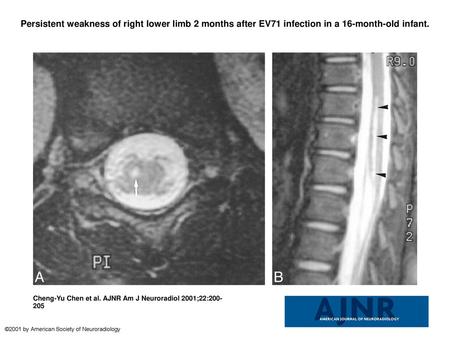 Persistent weakness of right lower limb 2 months after EV71 infection in a 16-month-old infant. Persistent weakness of right lower limb 2 months after.
