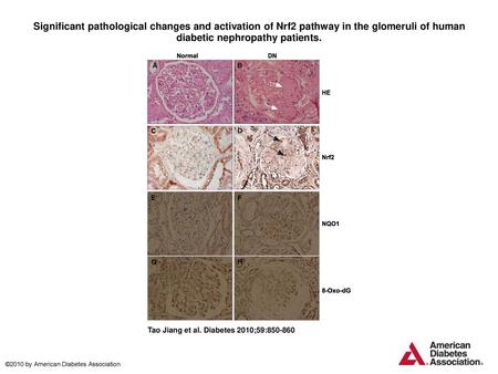 Significant pathological changes and activation of Nrf2 pathway in the glomeruli of human diabetic nephropathy patients. Significant pathological changes.