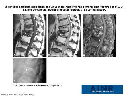 MR images and plain radiograph of a 73-year-old man who had compression fractures at T12, L1, L3, and L4 vertebral bodies and osteonecrosis at L1 vertebral.