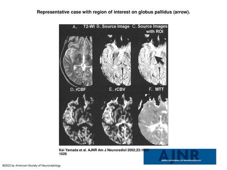 Representative case with region of interest on globus pallidus (arrow)
