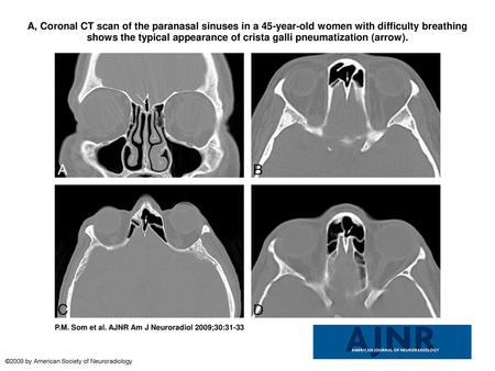 A, Coronal CT scan of the paranasal sinuses in a 45-year-old women with difficulty breathing shows the typical appearance of crista galli pneumatization.