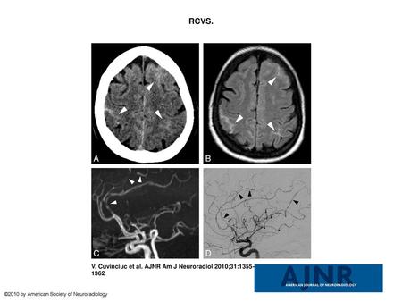 RCVS. RCVS. A, Axial brain CT scan shows bilateral frontoparietal sulcal SAH (white arrowheads). B, Axial FLAIR image confirms the cSAH (white arrowheads).