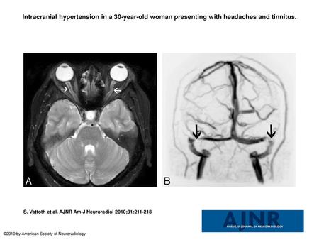 Intracranial hypertension in a 30-year-old woman presenting with headaches and tinnitus. Intracranial hypertension in a 30-year-old woman presenting with.