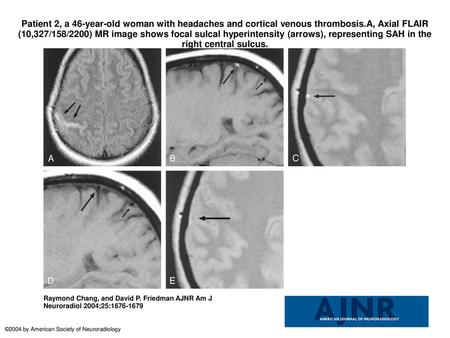 Patient 2, a 46-year-old woman with headaches and cortical venous thrombosis.A, Axial FLAIR (10,327/158/2200) MR image shows focal sulcal hyperintensity.