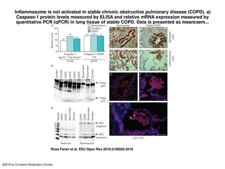 Inflammasome is not activated in stable chronic obstructive pulmonary disease (COPD). a) Caspase-1 protein levels measured by ELISA and relative mRNA expression.